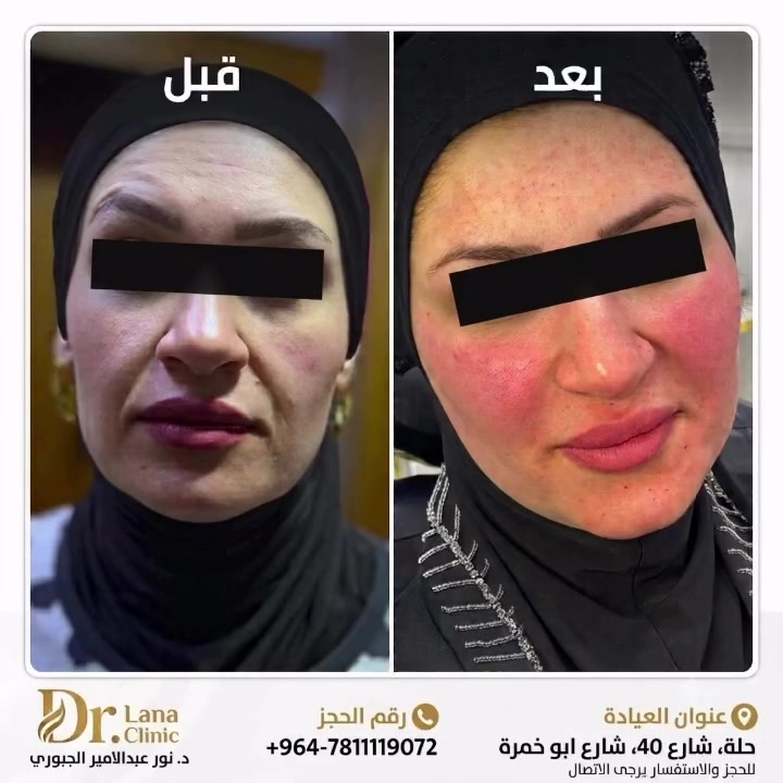 التغيير الصح من يكون بالإيد الصح 👍 المراجعة فاقدة وزن كبير و هذا الشي سبب نزول وترهل بالجلد وخسارة الوسادة الشحمية 😔 تم اعادة تفاصيل الوجه الجميله وبطريقة طبيعية ومتناسقة 😍 ✨ لانا كلينك – ابتسامتك تهمنا! ✨

نقدم لك أفضل خدمات طب الأسنان  وتجميل الوجه الغير جراحي بأحدث التقنيات لضمان راحتك وابتسامتك المثالية! 🦷💙

🔹 فحص شامل واستشارات متكاملة
🔹 علاجات متطورة وبأحدث الأجهزة 
📍 الموقع: حلة، شارع 40، شارع أبو خمرة
📞 للحجز والاستفسار: ***********

ابتسامتك سر ثقتك.. احجز موعدك الآن! 😁💫
