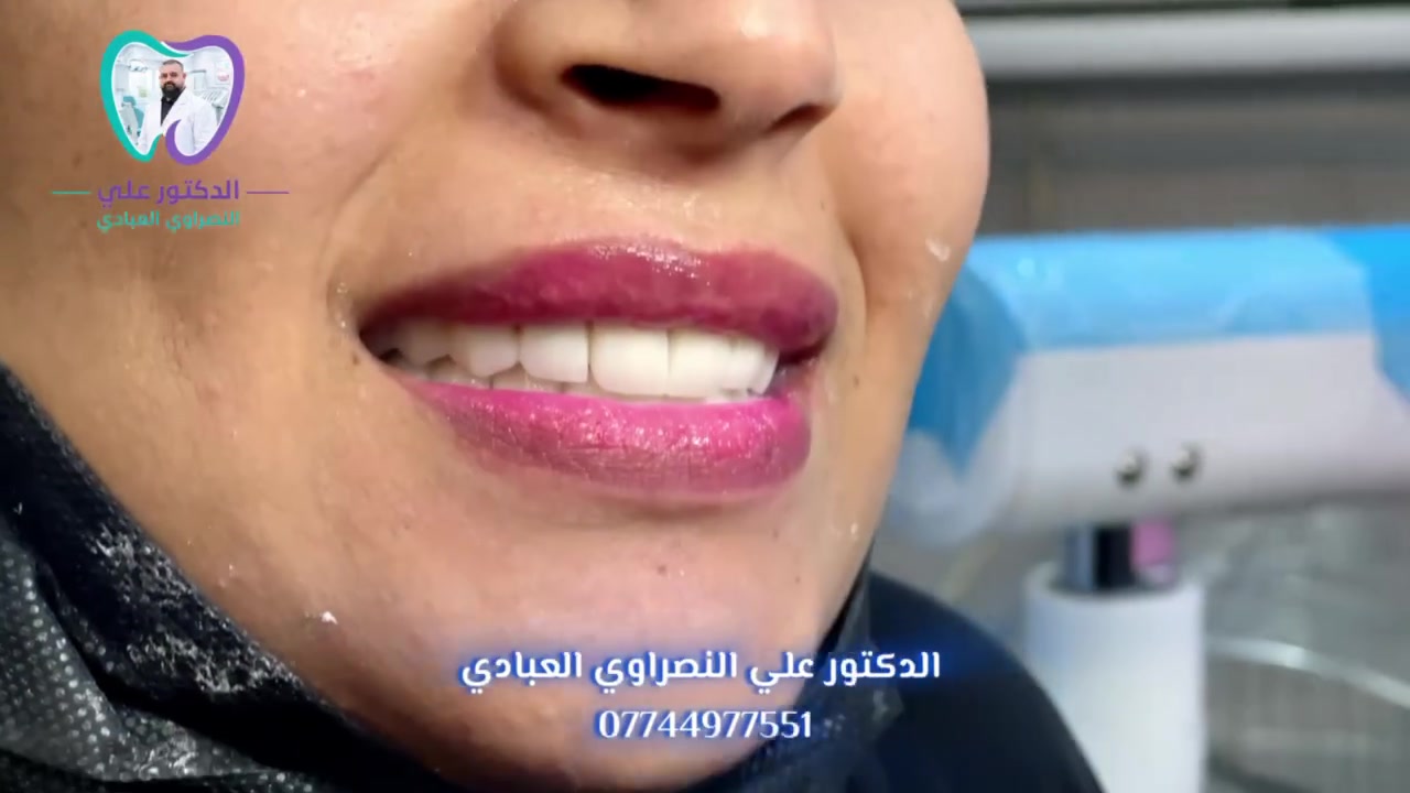 العنوان: ضحكتك.. هي سرّ جاذبيتك! ✨
📌📌📌((يتوفر لدينا نظامين الاقساط))  :
١- نظام الاقساط على ماستر كارد.
٢- نظام الاقساط العيادي .
مع خدمة العلاجية الأسنان مجانا  في ((عيادة الدكتور علي النصراوي العبادي ))
*********** / ***********
العنوان : الحرية ثالثة _ابوجفات مقابل أسواق الشمري / فوق مطعم دجاج الرحمن  
((الدكتور علي العبادي ))
دوام العيادة من الساعه  2 ظهرا إلى ٩ مساءا (اهلا وسهلا)
للحجز والاستفسار ⁉️⁉️⁉️
‏WhatsApp  
*********** / ***********
