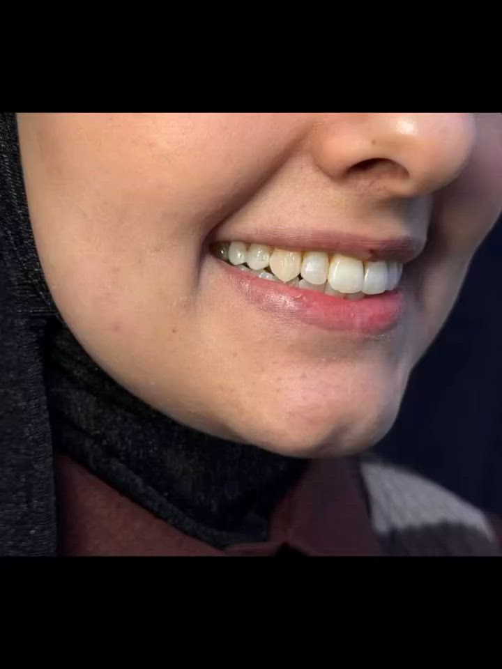 ✨ تقويم الأسنان صار أقرب إليكم ✨

لا تخلي تزاحم الأسنان أو الفراغات تأثر على ابتسامتك

🦷 تقويم الأسنان يمنحك ابتسامة أجمل وثقة أكبر

 بإشراف طبي ومتابعة مستمرة للحصول على أفضل النتائج

 للحجز والاستفسار تواصلوا معنا

***********
