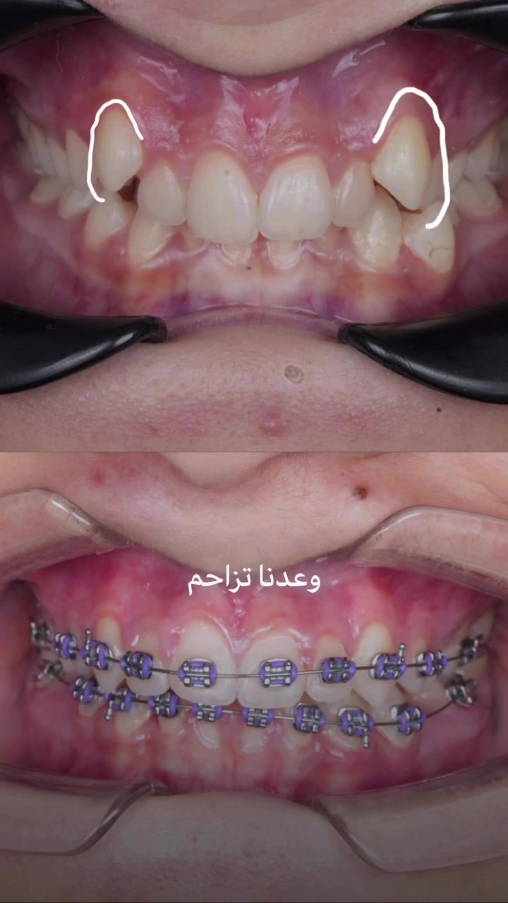 ٣ اشهر بس 🤍

كدرنا نحلص هذا الفرق و النتيجة بالأسنان و مستمرين بمرحلة العلاج 🫶🏻🤍. 

الدكتور مصطفى صالح @mustafa_salih96 

📍 بغداد – بنوك – شارع الجسر الجديد
📞 ***********

#مركز_الدكتور_مصطفى_صگبان #التقويم_الشفاف #Emax #أسنان #ابتسامه …

