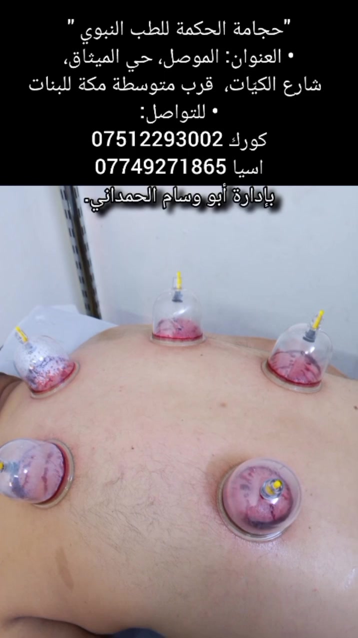 "حجامة الحكمة للطب النبوي "
• العنوان: الموصل، حي الميثاق،
 شارع الكيّات،  قرب متوسطة مكة للبنات
• للتواصل:
كورك ***********
اسيا ***********
بإدارة أبو وسام الحمداني.
