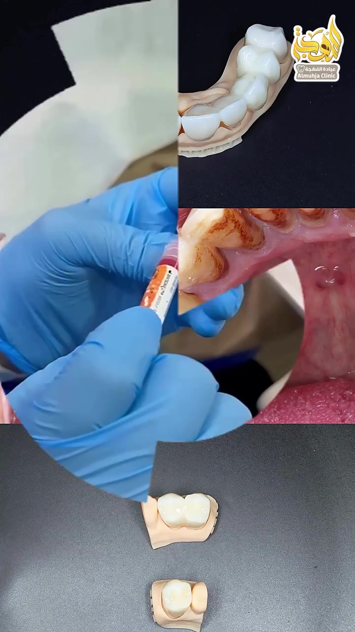 ✨ رحلة علاج مُتكاملة انتهت بإبتسامة راقية وطبيعية 😍🦷
👨‍⚕️ د. منتظر القريشي

لم تكن هذه الحالة مجرد تركيب أسنان بل خطة علاجية متكاملة بدأت بعلاج جذور الأسنان المتضررة 🦷، ثم إعادة بنائها بإستخدام الحشوات الضوئية لتوفير أساس صحي وقوي للتركيبات💪✨

بعد إكمال المراحل العلاجية، تم تركيب الأسنان من الزيركون الألماني 🇩🇪، مع اختيار اللون والشكل والأبعاد بعناية ودقة 🎨👌؛ لتنسجم مع الأسنان وملامح الوجه والإبتسامة وتمنح مظهرًا طبيعيًا🤍😁

📸✨ النتيجة النهائية أمامكم في الفيديو بعد إكمال جميع مراحل العلاج والتركيب.

🌿 عيادة المُهجة لزراعة وتجميل وتقويم الأسنان
📍 كربلاء المقدسة – شارع الجمهورية – مُجمع الجنائن
📞 ***********

#تركيبات_الزيركون #تجميل_الأسنان #علاج_الجذور #الحشوات_الضوئية #بناء_الأسنان تركيب_الأسنان ابتسامة_طبيعية عيادة_المُهجة كربلاء
