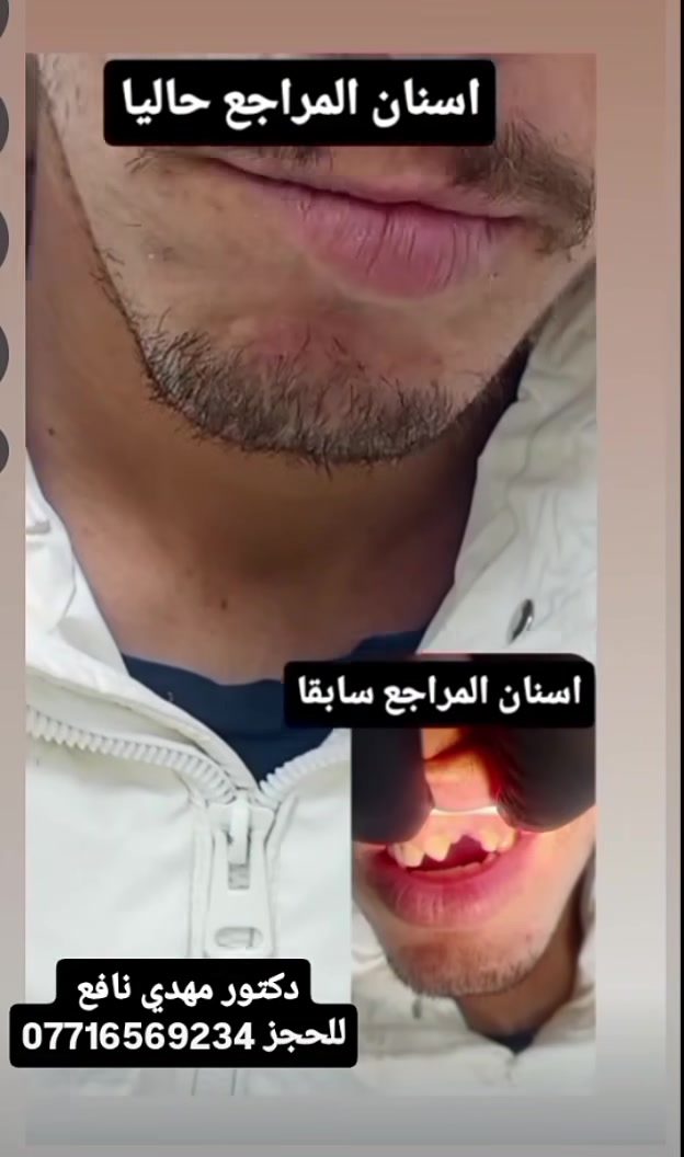 مراجعينا الاعزاء❤️
هدفنا نرجع ابتسامتكم الجميلة وانتو كلكم ثقة 
مثل هذا المراجع 

دكتور مهدي نافع 
للحجز ***********. يتوفر واتساب 

العنوان :- 
منطقة ال 4000_ مجاور محمد العكيلي للذهب - مجمع الجوادين الطبي ـ (عيادة الطائي لطب الاسنان )
