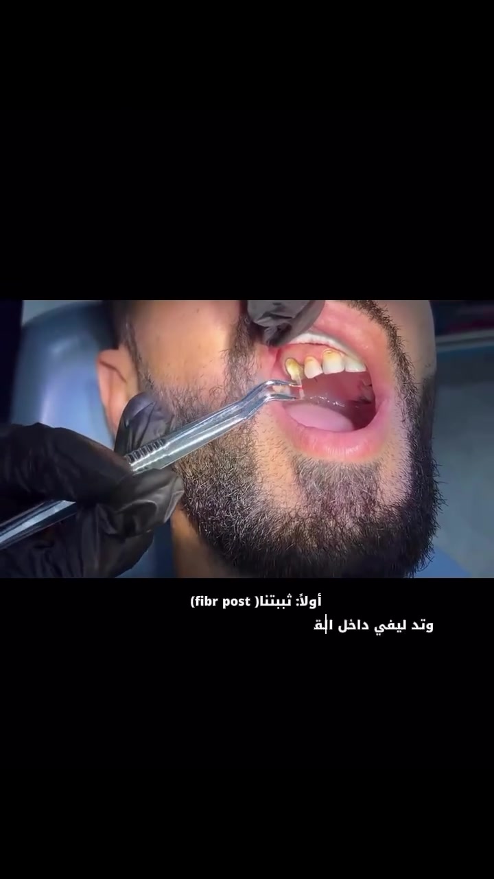 🦷 حشوات الجذر مع الفايبر بوست

إذا كان السن قد تعرض للكسر أو الضعف بعد سحب العصب، فإن استخدام الفايبر بوست يساعد على تقوية السن من الداخل، ليكون جاهزًا لتركيب التاج (الكراون) ويمنحه دعامة أفضل وعمرًا أطول.

📍 العنوان: بدرة – بناية المحامي خالد، مقابل مضيف الإمام الرضا (عليه السلام).
📞 للحجز والاستفسار: ***********
