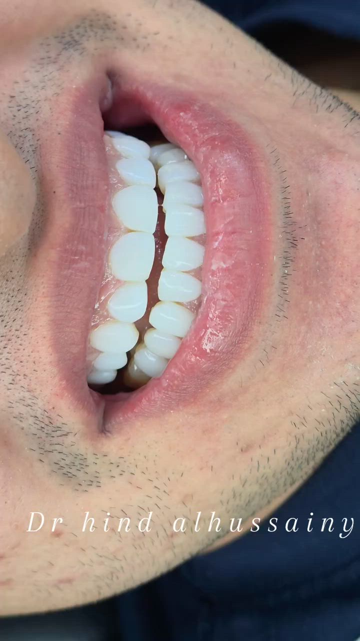 ✨ مو كل تغيير يحتاج برد ✨

قبل وبعد لمراجعنا الكرام😍
ابتسامة أجمل، لون أنصع، ومظهر طبيعي يحافظ على أسنانك ويمنحك طله  اجمل
عيادة دكتورة الدكتورة هند الحسيني 
***********
النواب/تقاطع الزهور/شارع المهداوي /مقابل عيادة النبأ

#ابتسامة_بدون_برد
#هوليود_سمايل
#تجميل_الاسنان
#اسنان_بغداد
#قبل_وبعد
