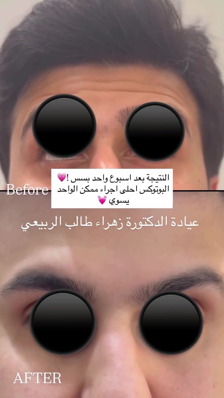 منو عنده هيج خطوط وضايج منها 

ضروري لمن تبلش عندك هيج خطوط تسويها لان اذا ماسويتهه وتركتهه تطبع ويبقى الخط موجود 💐💐 

البوتوكس هو الحل !!🌸🤍🤍🤍 

من احلى الاجراءات الي ممكن نشوف عليها فرق والمراجع او المراجعة يحبوها لان نتيجة سريعة 
❤️
 
العنوان المسيب شارع البلدية
للحجز والاستفسار فقط واتساب مسج ***********
