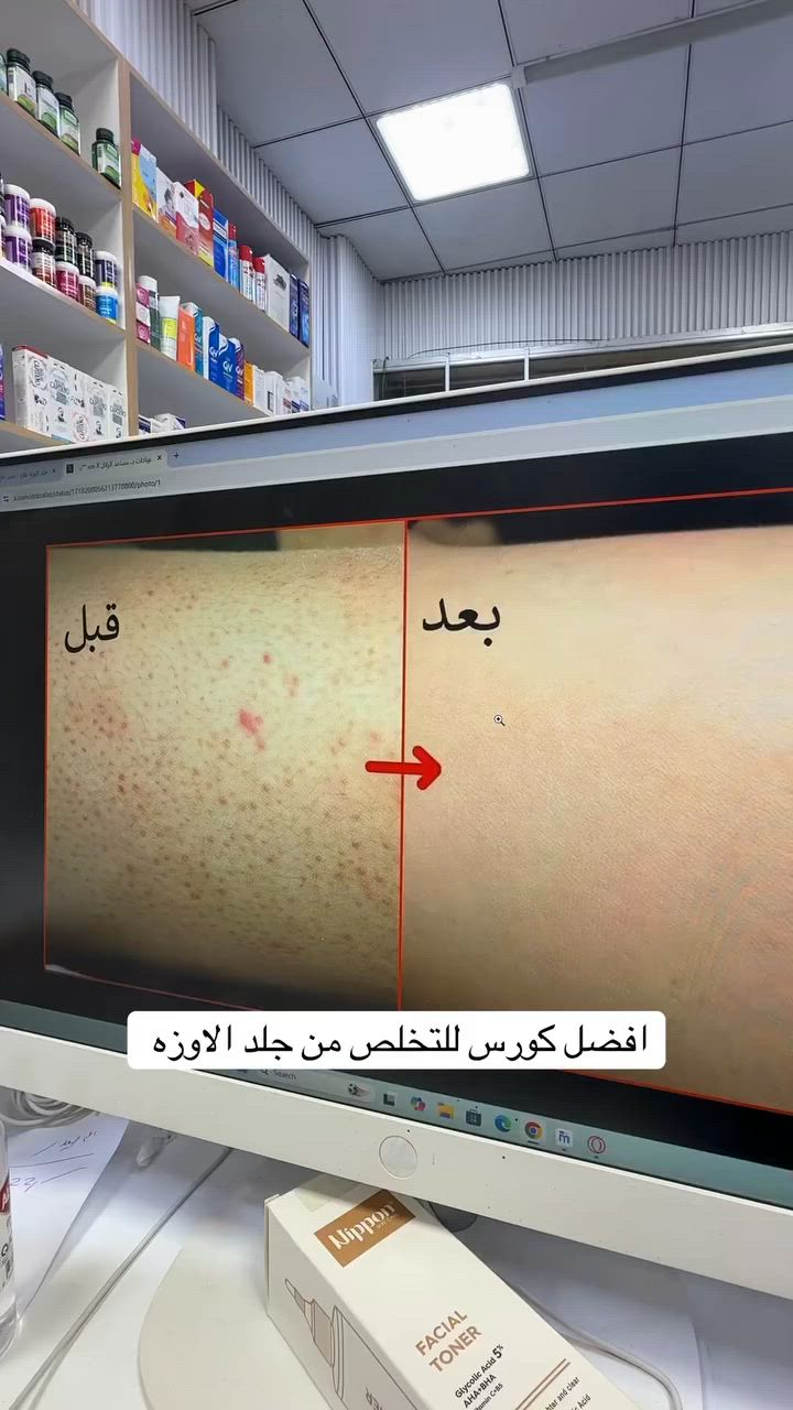 ✨ كورس جلد الأوزة ✨

🩵 Nippon Glycolic Acid 5%
🤍 Ladonaa Soothing Lotion

📌 طريقة الاستخدام:
🌙 مساءً: امسح المنطقة بـ Nippon Toner ثم بعد 5 دقائق ضع Ladonaa Lotion.
☀️ صباحاً: استخدم Ladonaa Lotion فقط.

🎯 الفوائد:
✨ تقليل جلد الأوزة والخشونة.
✨ تنعيم وترطيب البشرة.
✨ تحسين ملمس ومظهر الجلد.

⏳ النتائج تبدأ بالظهور خلال 4–8 أسابيع مع الاستمرار.

📍 متوفر لدى صيدلية تكريت 💙🧴


**إذا كنت صاحب هذا الإعلان وتريد حذفه لأي سبب، رجاءا أرسل رسالة إلى الدعم الفني**