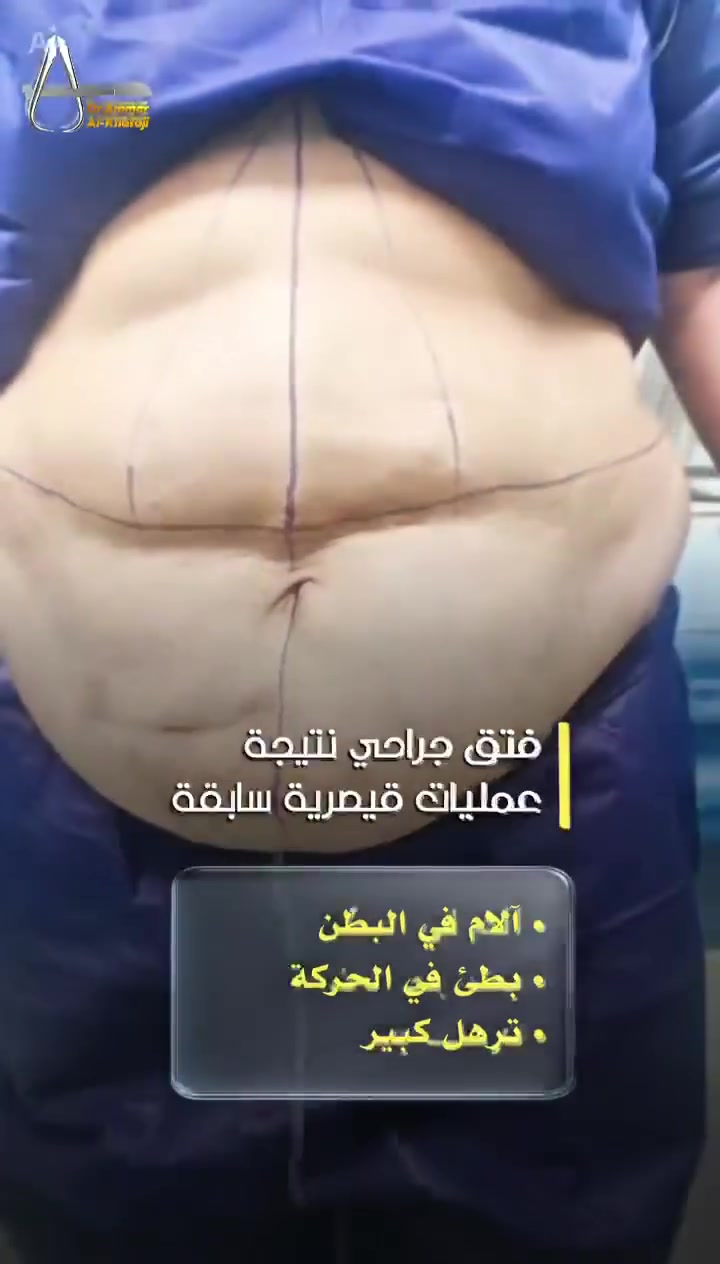 عملية فتق جراحي نتيجة عمليات قيصرية سابقة
الأعراض:
- آلام في البطن 
- بطئ في الحركة 
- ترهلات كبيرة 
_____________
النتيجة:
- تم إصلاح الفتق الجراحي 
- قص الترهلات 
- تكميم جدار البطن 
- شبكة لتقوية جدار البطن 
- ضمان عدم رجوع الفتق مع تجميل جدار البطن
- نزول 8 كيلو من وزن المريضة.
الحمد لله على سلامة الجميع. 

العنوان: #الناصرية / #البريد _ مجاور صيدلية #ميليا 
للحجز والاستفسار: ***********

#العراق / #عملية/ #صحة / #طب #جراحة
 #معاينة / #فتق_جراحي / #قص_الترهل /#تجميل / #جدار_البطن / #نزول_الوزن
