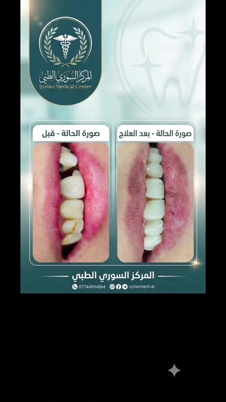 ابتسم دائماً ❤️
الشغل الصح ✅ بالمكان الصح✅🫡

(زراعة-تقويم-تغليف-تركيب)

#ملاحظة ضمان مدى الحياةأدواتنا استخدام واحد فقط

المياه المستخدمة أثناء المعالج معقمة(كاسات) 

للحجز والاستفسار مراسلة الصفحة أو الاتصال على الأرقام التالية ☎️*********** _***********

#اسنان #زراعة #تقويم #تغليف
المحمودية بغداد مدينة_الصدر

تيك توك 👇👇👇
￼https://www.tiktok.com/@mstk520?_t=ZS-8vKXPDhbuIm&_r=1

انستا 👇👇👇
https://www.instagram.com/lmrkzlswryltby/
profilecard/?igsh=Y2d5ODJ5Z3YwNWl3
