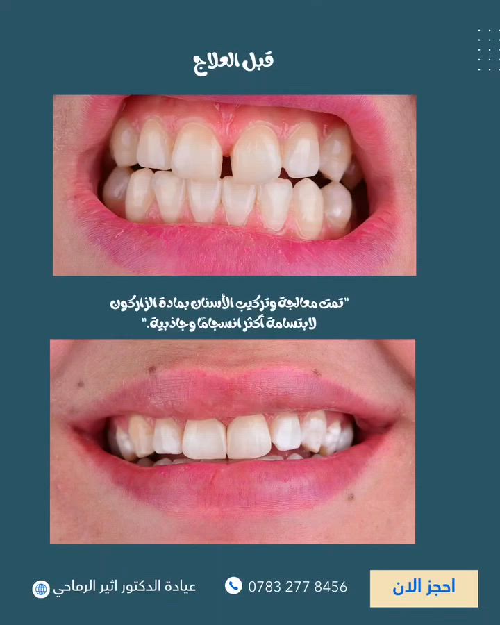 "لأن الابتسامة الجميلة تبدأ من التفاصيل الدقيقة" 
تم تصميم هذه الابتسامة بعناية فائقة باستخدام تركيبات الزيركون لتحقيق أعلى درجات الجمال والتناسق. ✨🦷

 (عيادة الدكتور أثير حليم الرماحي) 

☎️ للحجز والاستفسار ***********
او مراسلة الصفحة

📍 الموقع: 
الديوانية- قضاء عفك/شارع الأطباء قرب صيدلية أكرم البديري بناية الدكتورة مروة حمود التميمي الطابق الثاني

#ابتسامتك_تستحق_الأفضل
#عيادة_اسنان #قضاء_عفك
#حشوات_تجميلية_حشوات_جذور_تركيب_اسنان_ثابتة_ومتحركة_تبييض_اسنان_بالليزر_ابتسامة_المشاهير
#اكسبلور_explore
