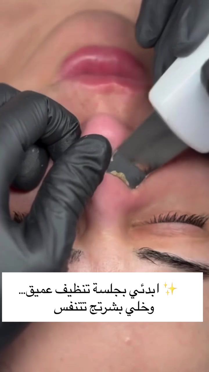 جلسه تنضيف بشره هيدروفيشيال 🤍🔥
فوائد تنضيف البشره :

✅-إعادة النضارة للبشرة الباهتة وتحسين ملمس البشرة.
✅-تقليل إفراز الزيوت في البشرة الدهنية 
✅-تخليص البشرة من الرؤوس السوداء والبيضاء.
✅-تحفيز الكولاجين الذي يعطي نتائج فورية.

العنوان الخاجيه شارع 40 داخل السوق لعصري 🌲 حبايبي اسم مالتنه نونه اكرلك ماعدنه غير فرع
***********
