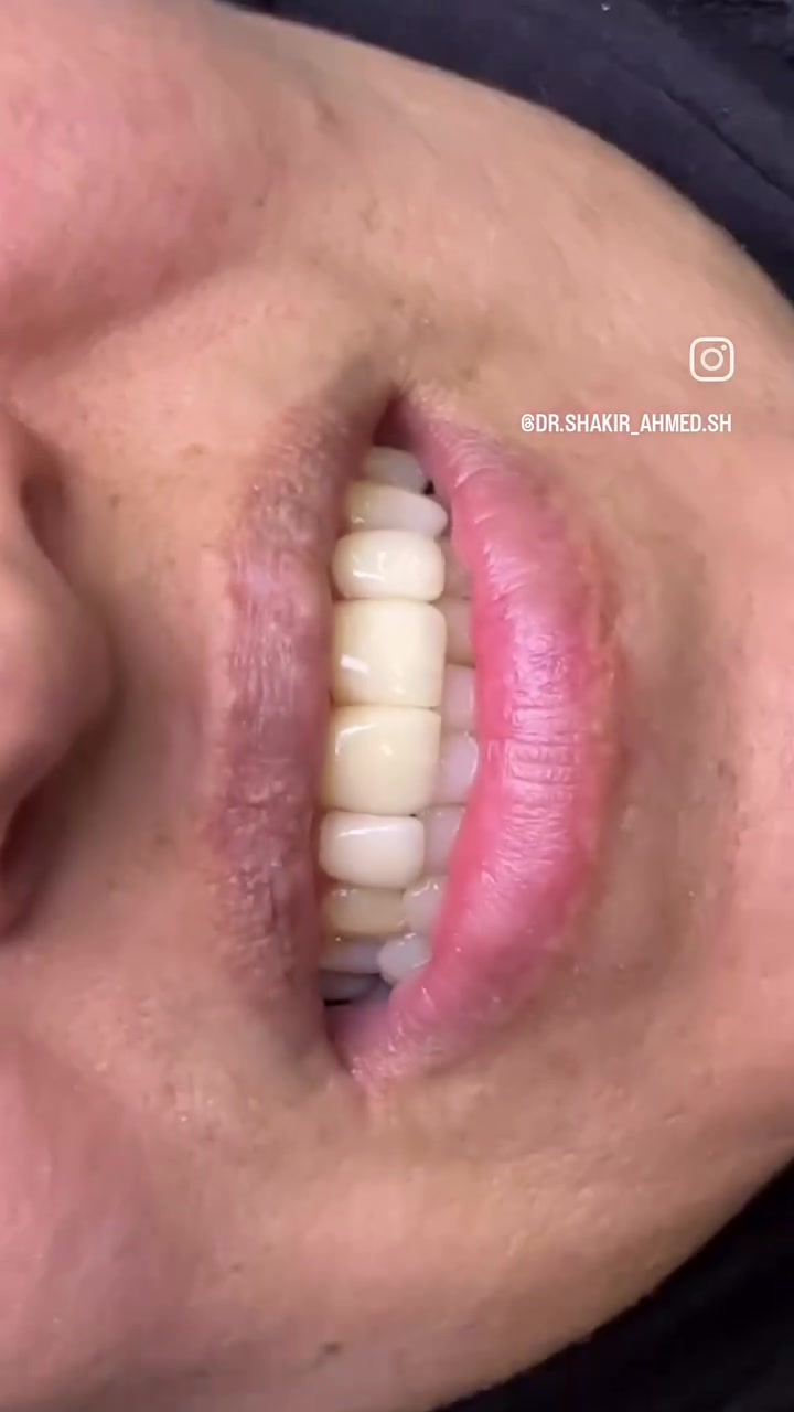 ابتسامتك تستحق الأفضل ✨🦷
إذا تبحثون عن ابتسامة أجمل وصحة أفضل لأسنانكم 🤍
نستقبلكم في عيادة الدكتور شاكر أحمد شاكر لتقديم خدمات طب وتجميل الأسنان 🦷✨
📸 نماذج من أعمال العيادة 👇🏻
نهتم بالتفاصيل حتى تحصلون على ابتسامة تليق بكم 🤍
📍 العنوان: قرب جسر ديالى القديم
📞 للحجز والاستفسار: ***********
✨ للحجز والاستفسار تواصلوا معنا ✨
#عيادة_الدكتور_شاكر_أحمد_شاكر
#طب_وتجميل_الأسنان
#تجميل_الأسنان
#ابتسامة_جميلة
#الزعفرانية
