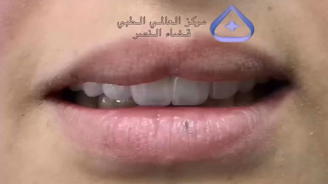 من نتائجنا التي نفتخر بها في مركز العالمي الطبي توازن مذهل بين فخامة التصميم وعفوية الملامح لتشرق ضحكتك بكل ثقة ورقيّ
من اعمال مركزنا المتميز🫡

‏‎مركز العالمي الطبي الخيري يقدم لكم جميع الخدمات الصحية 
و بكوادرها المتميزة وباسعار مناسبة جداً لخدمة عوائلنا الاعزاء …
‎
العنوان ذي قار قضاء النصر الصوب الكبير الفرع المقابل المصرف الاستفسار ***********

وكل الهلا بيكم تنورونا

#اكسبلور_فولو #اكسبلور_explore #exo #explorepage✨ #ريلز #ترند
 ‏ #تجميل_الاسنان #تجميل #تقويم_الاسنان #سكارلت #ليزر #ساينوشور #تنظيف_البشرة #هايدروفيشيال #اكسبلور #ابتسامة_المشاهير #بلاك_فرايدي #بلاك_فرايدي_فاشن_الملحم.
