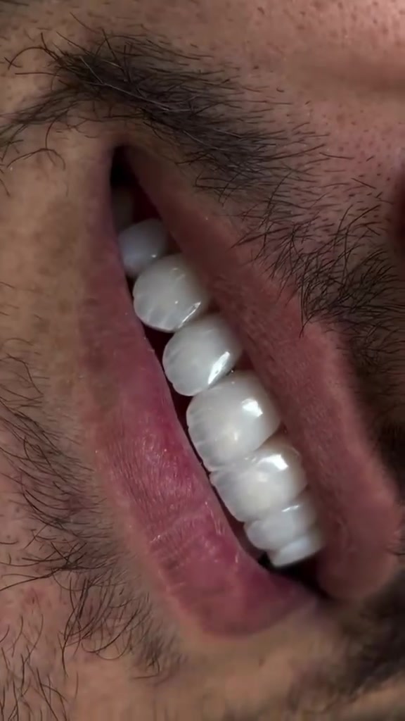 دقة، متانة، وجمال في كل ابتسامة🤍🤍✨
متواجدين طيلة أيام الأسبوع 
العنوان/القرنة/شارع المستوصف/عمارة شركة بغداد للحاسبات/للأستسفار/***********
 #الشركة الطبية العالمية
