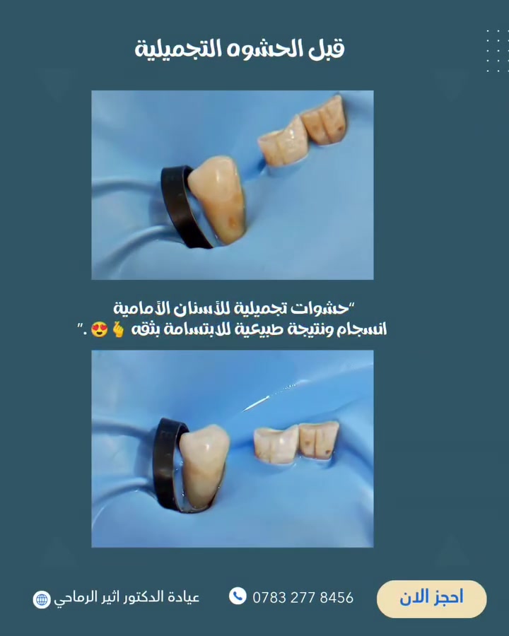 ابتسامة طبيعية تبدأ بترميمٍ متقن. ✨
حشوات تجميلية للأسنان الأمامية تعيد الانسجام إلى الابتسامة.😍

 (عيادة الدكتور أثير حليم الرماحي) 

☎️ للحجز والاستفسار ***********
او مراسلة الصفحة

📍 الموقع: 
الديوانية- قضاء عفك/شارع الأطباء قرب صيدلية أكرم البديري بناية الدكتورة مروة حمود التميمي الطابق الثاني

#ابتسامتك_تستحق_الأفضل #دکتور_اسنان
#حشوات_تجميلية_حشوات_جذور_تركيب_اسنان_ثابتة_ومتحركة_تبييض_اسنان_بالليزر_ابتسامة_المشاهير
#قضاء_عفك #اكسبلورexplore
