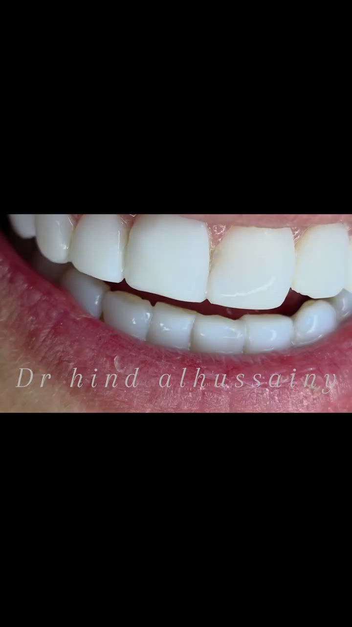 ✨ مو كل تغيير يحتاج برد ✨

قبل وبعد لمراجعنا الكرام😍
ابتسامة أجمل، لون أنصع، ومظهر طبيعي يحافظ على أسنانك ويمنحك طله  اجمل
عيادة دكتورة الدكتورة هند الحسيني 
***********
النواب/تقاطع الزهور/شارع المهداوي /مقابل عيادة النبأ

#ابتسامة_بدون_برد
#هوليود_سمايل
#تجميل_الاسنان
#اسنان_بغداد
#قبل_وبعد
