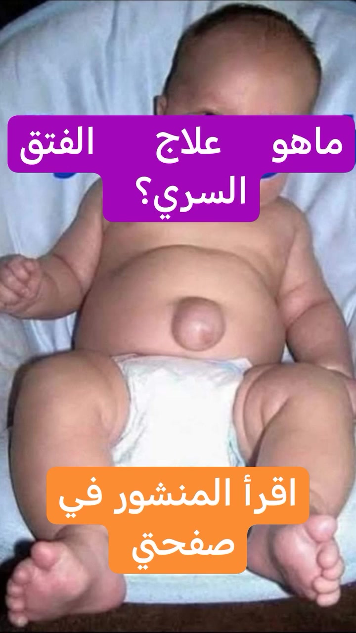 كل عام وانتم بألف خير وصحة وسلامة 

معلومه  عل سريع❤️💫👌

الفتق السري

 هو انتفاخ غير طبيعي يمكن رؤيته أو الشعور به في السرة يتطور هذا الفتق عندما يدخل جزء من بطانة البطن وجزء من الأمعاء  أو سائل من البطن عبر عضلة جدار البطن.

الفتق السري شائع  ويحدث في 10 إلى 20 في المائة من جميع الأطفال وانخفاض الوزن عند الولادة والأطفال الخدج هم أكثر عرضة للإصابة بالفتق السري.

 أسباب الفتق السرى؟

مع نمو الجنين أثناء الحمل  توجد فتحة صغيرة في عضلات البطن تسمح للحبل السري بالمرور  وربط الأم بالطفل، عندما ينمو الطفل بعد الولادة ، تنغلق هذه الفتحة في عضلات البطن ومع ذلك  في بعض الأحيان لا تلتقي هذه العضلات وتنمو معًا تمامًا  وتبقى فتحة صغيرة تسمى هذه الفتحة بالفتق السري.

علامات وأعراض الفتق السري

يظهر الفتق السري على شكل انتفاخ في منطقة السرة،  قد يصبح التورم أكثر وضوحًا عندما يبكي الطفل ، وقد يصبح أصغر أو يختفي عندما يكون الطفل هادئًا إذا قام الطبيب بدفع الانتفاخ برفق عندما يكون الطفل مستلقيًا وهادئًا ، فعادة ما يصغر حجمه أو يعود إلى البطن.

 كيف يتم تشخيص الفتق السرى ؟
 
يمكن للفحص البدني من قبل الطبيب تشخيص الفتق السري ويمكنه أيضًا تحديد ما إذا كان هناك أي محتويات في البطن محشورة في كيس الفتق.

 ما هو علاج الفتق السري ؟
 
يتم إغلاق العديد من الفتق السري تلقائيًا في سن 3 إلى 4 سنوات،  إذا لم يحدث الإغلاق بحلول هذا الوقت ، ينصح عادةً بإجراء إصلاح جراحي في الأطفال الأصغر سنًا  إذا كانت هناك نوبة حبس أو إذا كان الفتق كبيرًا جدًا  فقد يوصى بإجراء إصلاح جراحي ويتم إجراء الجراحة لإصلاح الفتق تحت التخدير العام

ملاحظات سريعة

📍 معظم الحالات تتشافى بدون أي عملية جراحية و لا تحتاج أي علاج .

📍 لا تسبب ألماً للطفل و لكن انتفاخها يزداد بحالات البكاء او مع الغازات .

📍 إذا تأخر الفتق الى بعد 4 سنوات و لم يتشافى ، من الممكن إجراء عملية جراحية لعلاجه .

📍 لا ينصح بوضع قطع معدنية فوق الفتق لعدم الفائدة من ذلك .

📍 بعض الناس يستخدمون الحزام ولكن لا دليل علمي قوي يدعم أستخدامه .

📍 أحيانًا يكون الفتق السرّي مصاحبًا لبعض الحالات المرضية مثل خمول الغدة الدرقية و بعض المتلازمات مثل متلازمة داون وهرلر و غيرها .

دمتم واطفالكم بألف خير

الدكتور
احمد محمود عبدالله
طبيب الأطفال والخدج وحديثي الولادة

العنوان
بغداد حي الحسين مجمع التقى الطبي قرب مجمع النمور مقابل كوزمتك الفرج 

للحجز والاستفسار
***********
