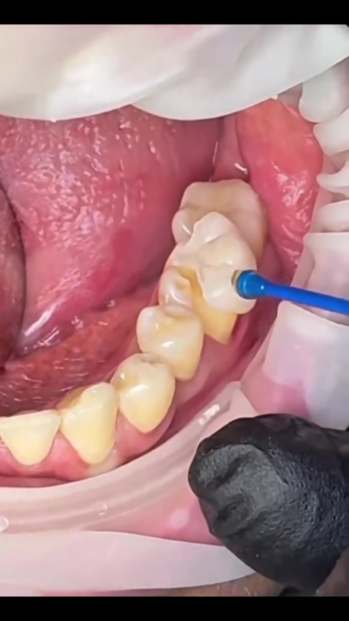 أنطي سنّك فرصة يرجع مثل الطبيعي! ✨🦷
الحشوات المختبرية مو بس شكلها أجمل، حتى أقوى وتعيش أكثر، وتنصنع بدقة حتى ترجعلك الابتسامة بثقة 

 ***********
