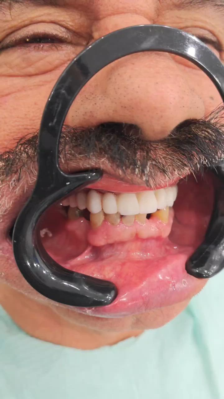 🦷 ابتسامتك الجديدة تبدأ من يوم العملية
تركيب أسنان مؤقتة مباشرة بعد زراعة الفك الكامل، لتستعيد الشكل والوظيفة والابتسامة بثقة من اليوم الأول، مع استبدالها لاحقاً بتركيبات الزركون النهائية بعد اكتمال التئام اللثة وضمان الاندماج الكامل للزرعات مع العظم.
✨ نتائج فورية ✨ مظهر طبيعي ✨ راحة وثقة أكبر خلال فترة الشفاء
#الدكتور_علي_الغريفي #سبع_البور #شارع_الالف #زراعة_اسنان #زراعة_الفك_الكامل #ابتسامة_جديدة #تركيبات_زركون #DentalImplants


**إذا كنت صاحب هذا الإعلان وتريد حذفه لأي سبب، رجاءا أرسل رسالة إلى الدعم الفني**