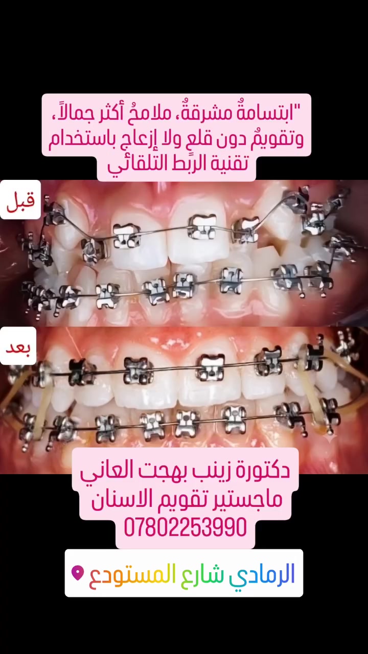 لماذا نفضل تقنية "الربط التلقائي" في حالاتنا؟ 🦷💡

​كثير من مراجعينا يخشون فكرة "قلع الأسنان" للحصول على ابتسامة مثالية. الخبر السعيد أن التكنولوجيا الحديثة، وتحديداً أجهزة الربط التلقائي (Self-Ligating)، غيرت قواعد اللعبة!

​كيف عملنا على هذه الحالة؟

​توسيع القوس السني: الجهاز يعمل بقوة خفيفة ومستمرة تسمح للأسنان بالاصطفاف دون الحاجة لمساحات إضافية ناتجة عن القلع.

​إسناد الشفة: من خلال ضبط ميلان الأسنان الأمامية بدقة، استعدنا الدعم الطبيعي للشفة العليا، مما أضفى مظهراً أكثر شباباً وتوازناً لبروفايل الوجه.

​تطابق مثالي: الهدف ليس فقط رصف الأسنان، بل الوصول إلى إطباق وظيفي يحمي مفصل الفك ويضمن استدامة النتائج.

​التقويم ليس مجرد أسنان مستقيمة، هو هندسة متكاملة لوجهك.

شاهدوا التحول الرائع في الصور..

👇 شاركونا آراءكم في التعليقات!

دكتورة زينب بهجت العاني 
ماجستير تقويم الاسنان 
الرمادي-شارع المستودع-عمارة الحاسبات-قرب مرطبات زنبقة 
احجز موعدك الان ***********
فيس Dr Eman Ayad alani 
انستا دكتورة إيمان اياد العاني Dr Eman Ayad alani
#تقويم_اسنان #شارع_مستودع #الرمادي #شارع_المستودع_الرمادي #عيادة_اسنان

