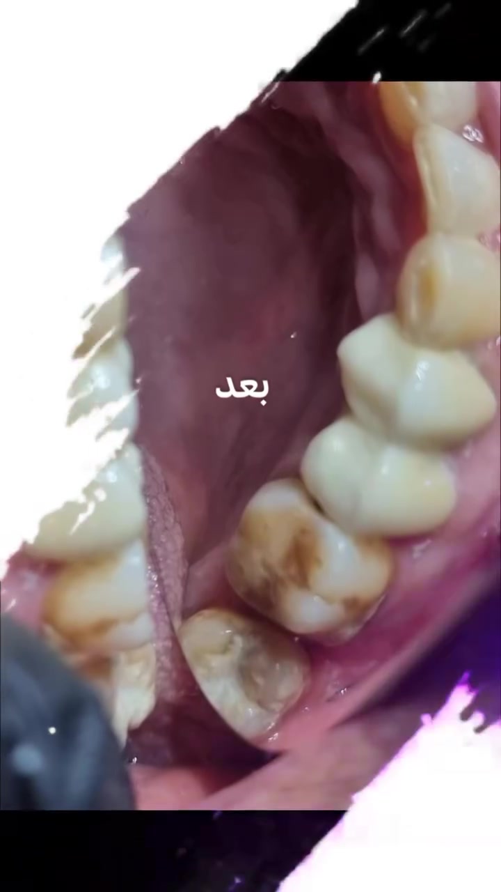 من أعمالنا اليومية في  عيادتنا✨💙 

تغليف الاسنان بالزاركون🦷

#عيادة_كوثى_لطب_وتجميل_الاسنان
#الدكتور_علي_حسن_العزاوي 
جبله/نهاية شارع الاطباء
مقابيل الدكتوره ميثاق المعموري

***********//للاستفسار
