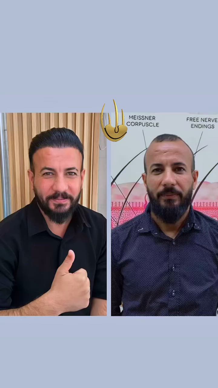 #رجع_مظهر_شبابك_وغير_صورك_مع_عروض_مركزنا👍🏻
              🔥🔥عــرض خــاص🔥🔥
يعلن مركز بغداد التخصصي لزراعة الشعر عن
                😍 نظام الاقساط 😍

⭐️️القسط الشهري بدون مقدمه 
لحاملي بطاقة الماستر كارد الرافدين حصرآ❤️‍🔥

⭐️يوجد لدينا ايضآ عرض vip الملكي 👑

 ⭐️ويستمر العرض التخفيض الذهبية 825 الف عراقي 🔥

الزراعه بجلسه وحده بدل من جلستين😍 
        
           👇عرضنا يتضمن👇

💚10 جلسة بلازما + 10 جلسة ميزو الاسباني للشعر 💉💉
💚3 جلسات بلازما + 3 جلسات ميزو للوجه تبيض ونضاره 💎
💚نتائج ممتازه باستخدام ✨️تقنية السفير ✨️
💚معاينه مجانيه 
💚عملية الزراعه بدون الم و بأعداد مفتوحه من البصيلات
💚شامبو طبي مجاني🧴 
💚متابعه مجانيه بعد العملية من قبل الكادر لمدة سنه 🆓
💚رسمة خط الجبهة بصوره احترافيه 🖌
💚حقيبة علاجية💫 
💚تحاليل وفحوصات ما قبل الزراعة 🩺
💚غسل الشعر بعد العملية وعناية بالشعر المزروع🚿
💚وجبة طعام 🥘 فاخره
💚والاهم من هذا كلة ننطيك شهادة ضمان مدى الحياة يعني اذا بعد ٤٠ سنه صارت عندك تساقط او خفة تجي وتجيب الضمان وتعيد الزراعة مجانا💫📜

       
💚العمليه اتكون تحت اشراف طبيب 🥼🩺مختص👨‍⚕️

💚العنوان💙بغداد المنصور _شارع مول بابلون _البناية الحمراء مجاور محل مارينا للاحذية والحقائب النسائية❤️

💚للحجز والاستفسار مراسلة الصفحة 
أو الاتصال على الارقام التالي: 
***********   
***********
***********
  أو وتس اب

أهـــلا وسهــلآ بــــكم في مركــزنا♥️ ♥️
