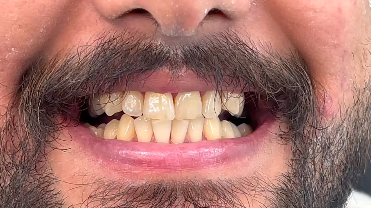 عيادة الطائي لطب الاسنان ♥️

جلسات تنظيف الاسنان راح نرجعلك عن طريقها الضحكة النظيفة الي راح تخلي ثقة بنفسك تزداد ✅

 عيادة الطائي لطب الاسنان

للحجز *********** واتس اب 
أو على الرقم *********** 

 #سبعالبور #التاجيات #التاجي #سبع_البور

