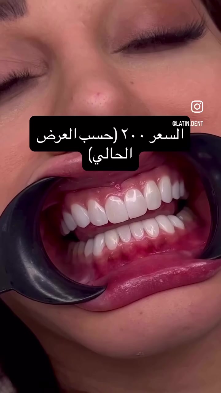✨ غيّر ابتسامتك وخلّي ثقتك أكبر! 😁
إذا تحلم بابتسامة ناصعة وطبيعية، ابتسامة هوليوود بدایموند ألماني أصلي هي الخيار الأمثل لك.

🦷 20 سن دايموند ألماني أصلي
💎 مظهر طبيعي ولمعان يدوم
💰 السعر الحالي: 200 ألف دينار فقط (لفترة العرض)

📍 Latin Dent لطب وتجميل الأسنان
بغداد – حي القاهرة – قرب جامع النداء

📞 للحجز والاستفسار:
***********

احجز موعدك اليوم وابدأ رحلتك نحو ابتسامة أجمل. ✨

#ابتسامة_هوليوود #دايموند_ألماني #تجميل_الأسنان #بغداد #لاتين_دنت #عيادة_أسنان #ابتسامة_مثالية #عروض_الأسنان #HollywoodSmile
