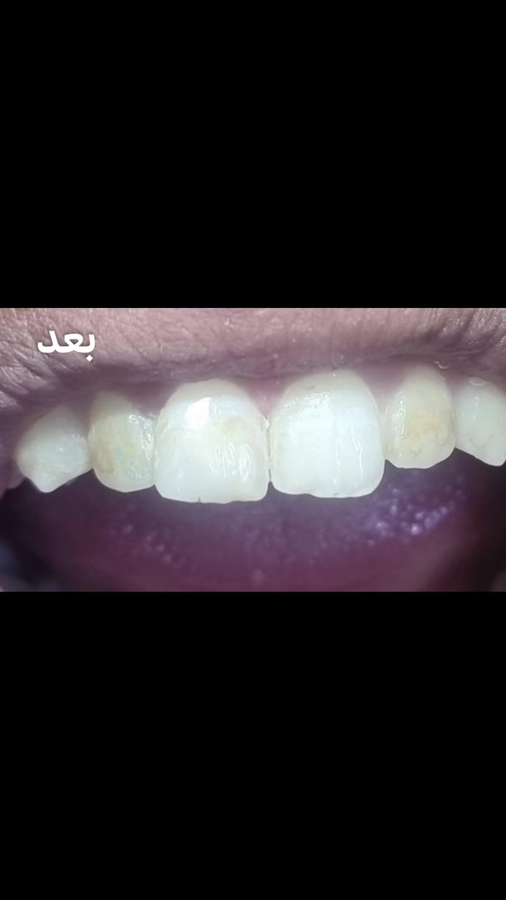 حشوة تجميليه للسن الامامي 🦷

اعادة للرسم التشريحي بدقة متناهية وارجاع السن الى الوضع الطبيعي✨💙

#عيادة_كوثى_لطب_وتجميل_الاسنان
#الدكتور_علي_حسن_العزاوي 
جبله/نهاية شارع الاطباء
مقابيل الدكتوره ميثاق المعموري

***********//للاستفسار
